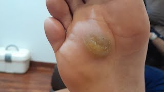 Calluses with corn Remove treatmentPart 1satisfying footcomfort footcare footcallous foot skin [upl. by Eurydice]