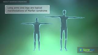 Marfan Syndrome About [upl. by Lusar]