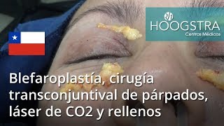 Blefaroplastía cirugía transconjuntival de párpados láser de CO2 y rellenos 17053 [upl. by Aetnahc]