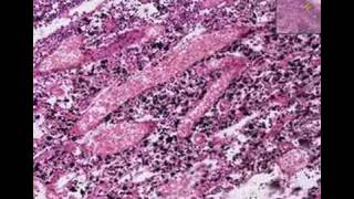 Histopathology Lymph nodeAnthracosis tuberculosis [upl. by Mcnelly]