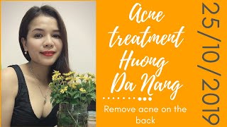 Acne treatment Hương Đà NẵngRemove acne on the back 25102019 [upl. by Arocahs]