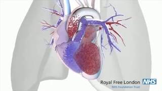 What is pulmonary hypertension [upl. by Arette]