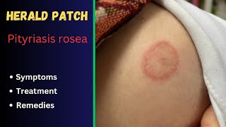 Herald patch  Pityriasis rosea  Causes Symptoms and Treatment [upl. by Elyad]