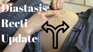 Diastasis Recti 2nd Pregnancy [upl. by Thorbert]