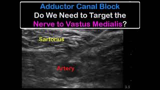 Adductor Canal Block  Does Nerve to Vastus Medialis Have To Be SEPARATELY Targeted [upl. by Karolyn]