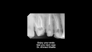 Upper posterior endodontic rehabilitation [upl. by Eciened594]