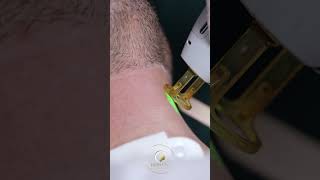 Laser Beard Shaping Dubai  beardshaping laserhairremoval candelagentlemaxpro [upl. by Neibart749]