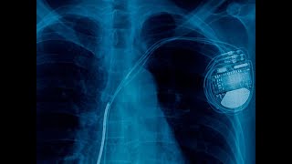 Automatic Implantable CardioverterDefibrillator AICD Explained CureU Healthcare cureuhealthcare [upl. by Zebada833]