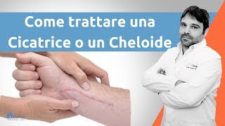 Come trattare una cicatrice cheloide [upl. by Ymmor]