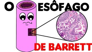 Histologia do Esôfago 3 Esôfago de Barrett [upl. by Eimmat680]