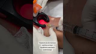 Tratamento de microvarizes e vasinhos com laser transdermico [upl. by Toland93]