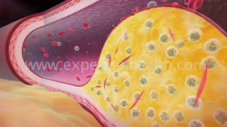 Clot Formation  Understanding High Blood Pressure [upl. by Mumford]