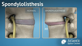 Spondylolisthesis [upl. by Nate731]