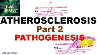 ATHEROSCLEROSIS  Part 2 Pathogenesis [upl. by Ogaitnas]