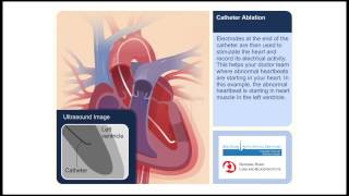 Catheter Ablation Animation Video [upl. by Eeralav156]