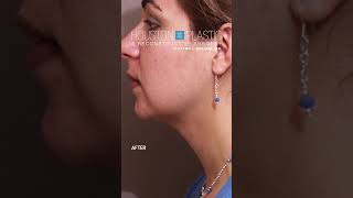 Neck liposuction before and after plasticsurgeon neckliposuction [upl. by Deanne280]