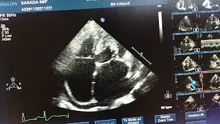 Biatrial dilatation  RCMP [upl. by Ecinaj]