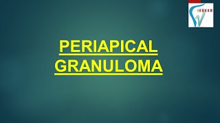 PERIAPICAL GRANULOMA  HINDI [upl. by Arick977]