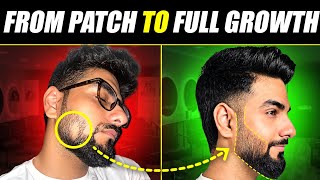 This is How I Treated a DANGEROUS Beard Patch 😰 Alopecia Areata Treatment  The Gabru Life [upl. by Wandie]