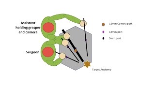 Learning Laparoscopic Sigmoid Colectomy High Anterior Resection [upl. by Ronyar]