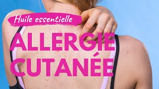 Allergie cutanée et huile essentielle [upl. by Ydeh]