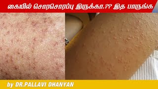 Keratosis Pilaris  Skin facts  Dermatologist Dr Pallavi Dhanyan [upl. by Ayhdnas]