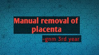 Manual removal of placenta note gnm 3rd year [upl. by Medeah88]