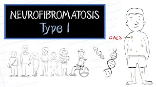 What is Neurofibromatosis Type 1 NF1 [upl. by Elke414]