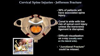 Jefferson Fracture  Everything You Need To Know  Dr Nabil Ebraheim [upl. by Netsirk34]