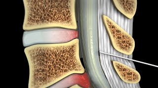 Epidural Steroid Injections [upl. by Yllaw311]