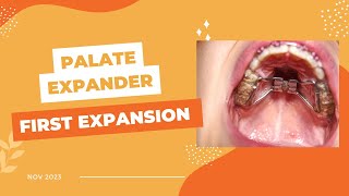 First Expansion of Palate Expander [upl. by Saxena]