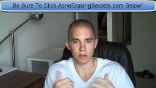 Acne Skin Treatment  Best Way To Get Rid Of Acne Fastest [upl. by Atsyrk]