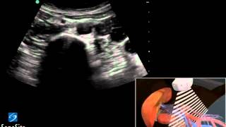 3D Cómo hacer Ecografía de Aorta Abdominal  Ultrasonido SonoSite [upl. by Ramahs]