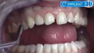 Fatete dentare la Implant3D Fixpeloc [upl. by Thia865]