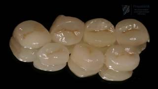 Case study The difference between veneers partial crowns and crowns [upl. by Odrautse]