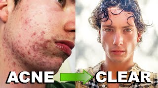 MY ACCUTANE JOURNEY  Clearing 6 Years of Acne Big Acne Transformation [upl. by Jotham]