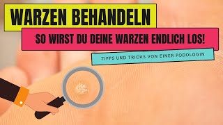 WARZEN BEHANDELN  So wirst du WARZEN endlich los [upl. by Surbeck513]