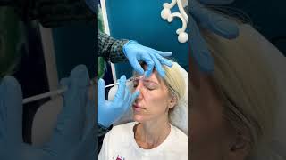 Xeomin Injections At Palm Beach  Xeomin Smart Toxin Injection shorts youtubeshort xeomin [upl. by Nytsirk]