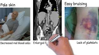 Leukemia  Easy explained  types of Leukemia and prognosis [upl. by Ary]