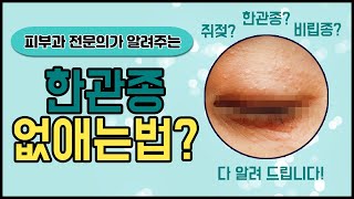 한관종 원인과 제거방법 공개 feat 비립종편평사마귀쥐젖 [upl. by Ailugram928]