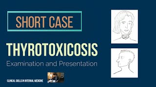 Thyrotoxicosis  Short Case [upl. by Anitirhc]