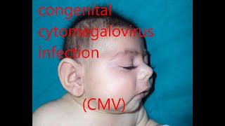 congenital cytomegalovirus infection CMV [upl. by Bass128]