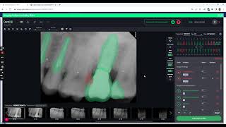 Dentrix Ascend Auto Charting Detect Denti AI [upl. by Franklyn503]