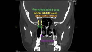 Coronal CT anatomy of Foramen Rotundum and Pterygopalatine Fossa [upl. by Thetes]