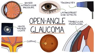 Understanding Open Angle Glaucoma [upl. by Mack]