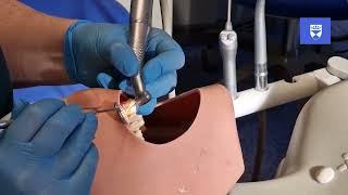 Traumatic dental injuries Splint removal procedures [upl. by Mandler]