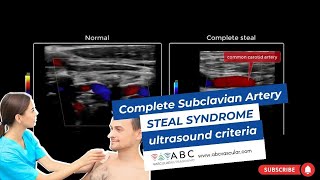 Complete Subclavian Artery Steal Syndrome ultrasound criteria [upl. by Kay]