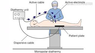 How diathermy works [upl. by Sinoda]