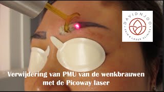 Verwijdering van PMU van de wenkbrauwen met de Picoway laser [upl. by Euqitsym]