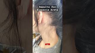 Alopecia Areata Treatment Houston Trichologist alopecia hairloss [upl. by Acirdna694]